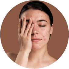 Pimples